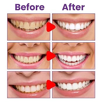 [20% DESCUENTO] Crema Blanqueadora Dental de Alta Eficacia